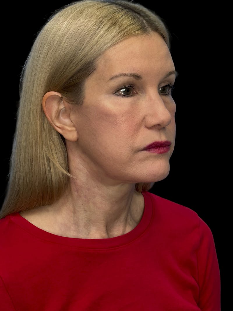 Brow Lift Before & After Gallery - Patient 350884 - Image 4