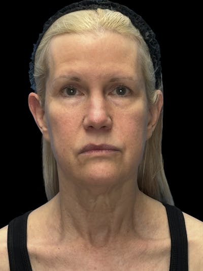 Brow Lift Before & After Gallery - Patient 350884 - Image 1