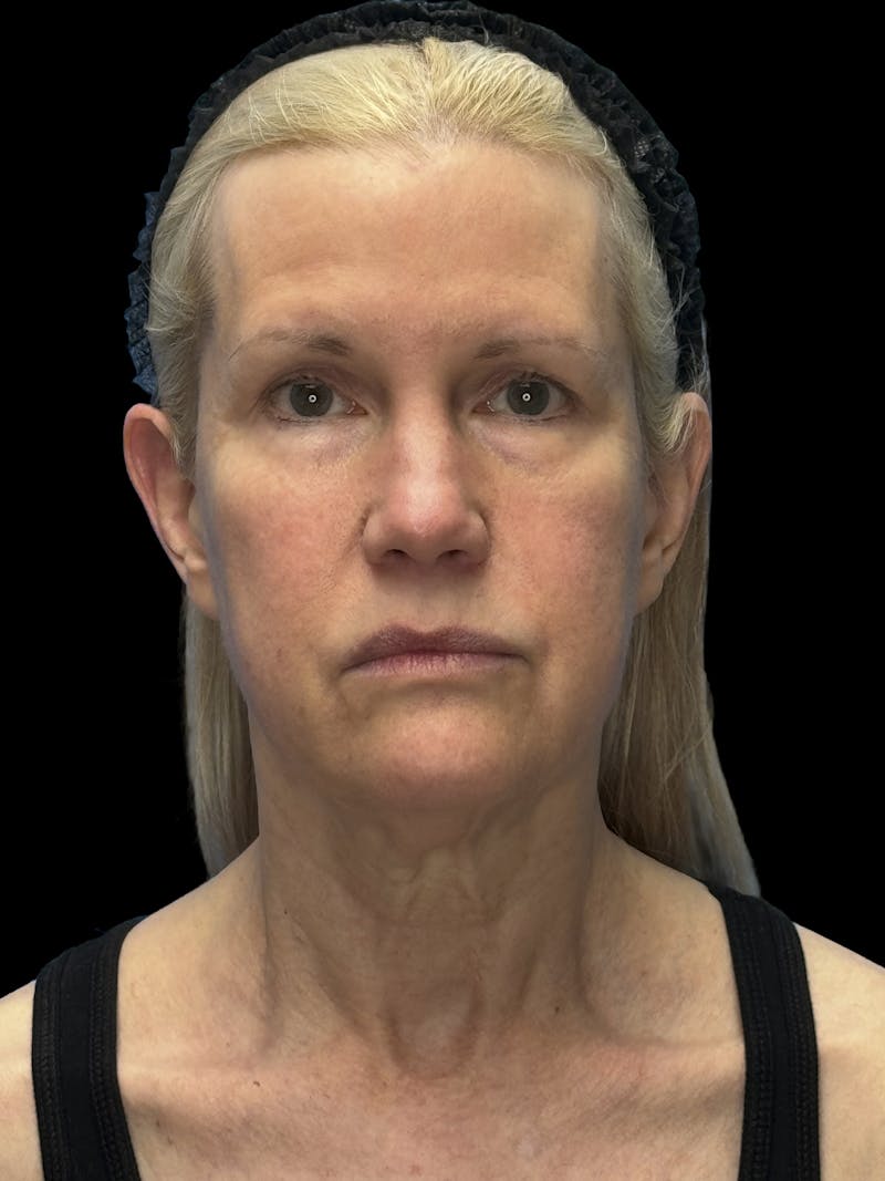 Brow Lift Before & After Gallery - Patient 350884 - Image 1