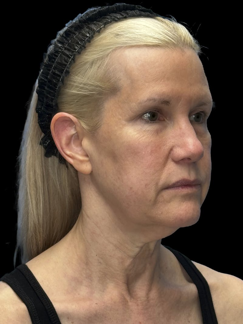 Brow Lift Before & After Gallery - Patient 350884 - Image 3