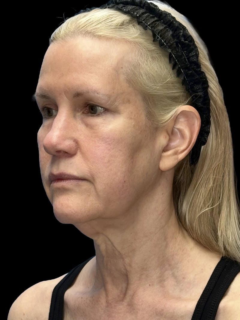 Brow Lift Before & After Gallery - Patient 350884 - Image 5