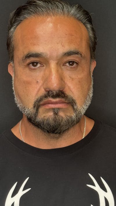 Lower Eye Rejuvenation Before & After Gallery - Patient 293519 - Image 2