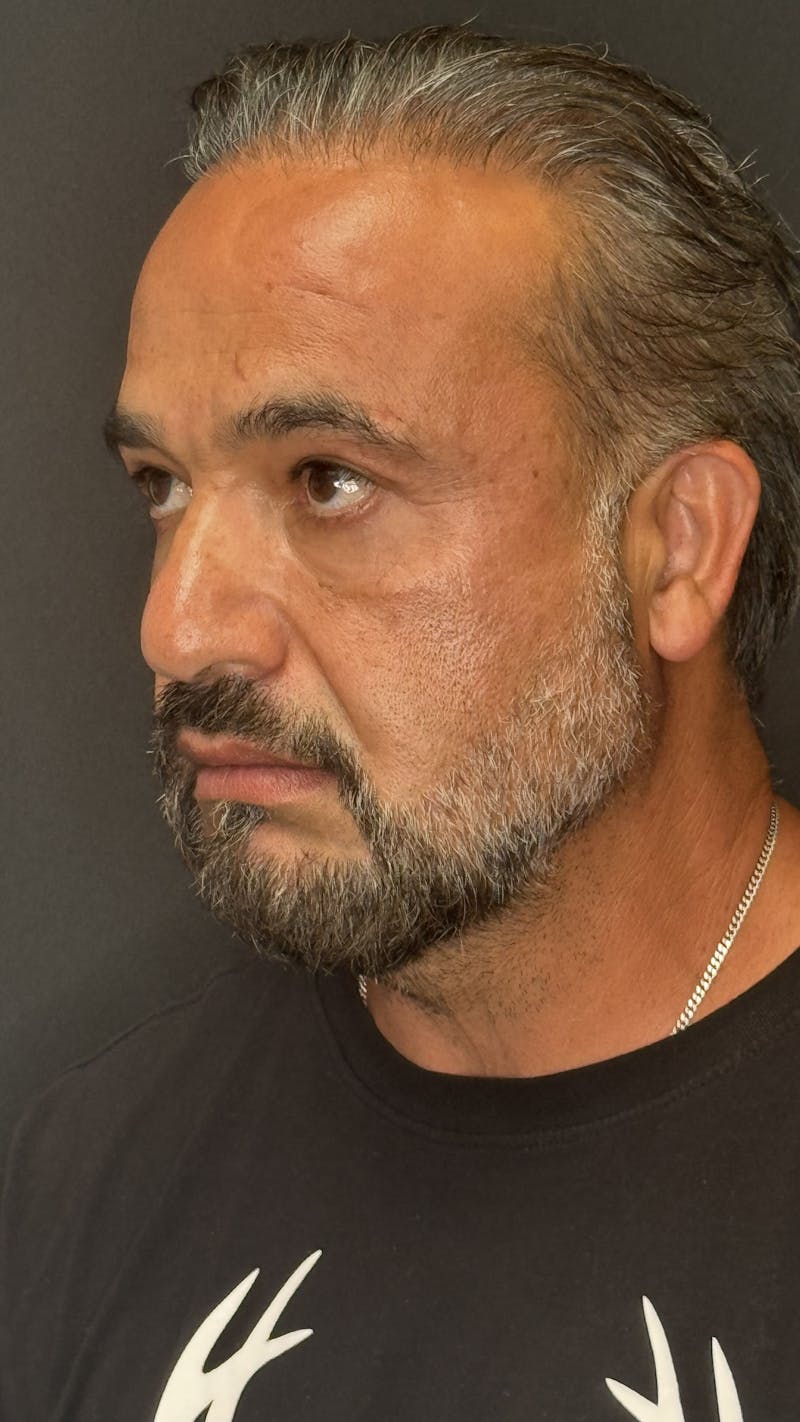 Lower Eye Rejuvenation Before & After Gallery - Patient 293519 - Image 6