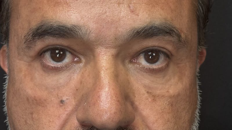 Lower Eye Rejuvenation Before & After Gallery - Patient 293519 - Image 8