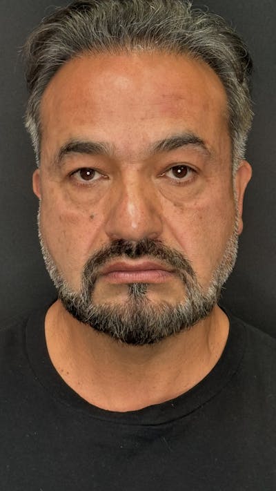 Lower Eye Rejuvenation Before & After Gallery - Patient 293519 - Image 1