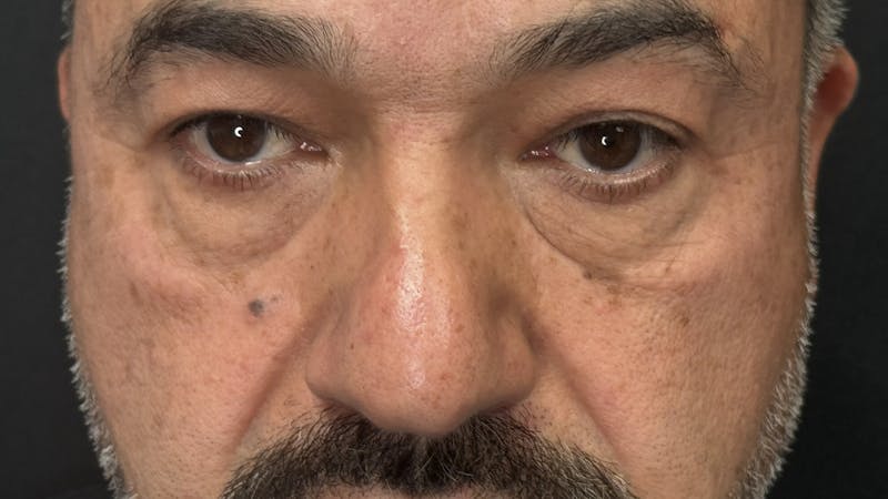 Lower Eye Rejuvenation Before & After Gallery - Patient 293519 - Image 7