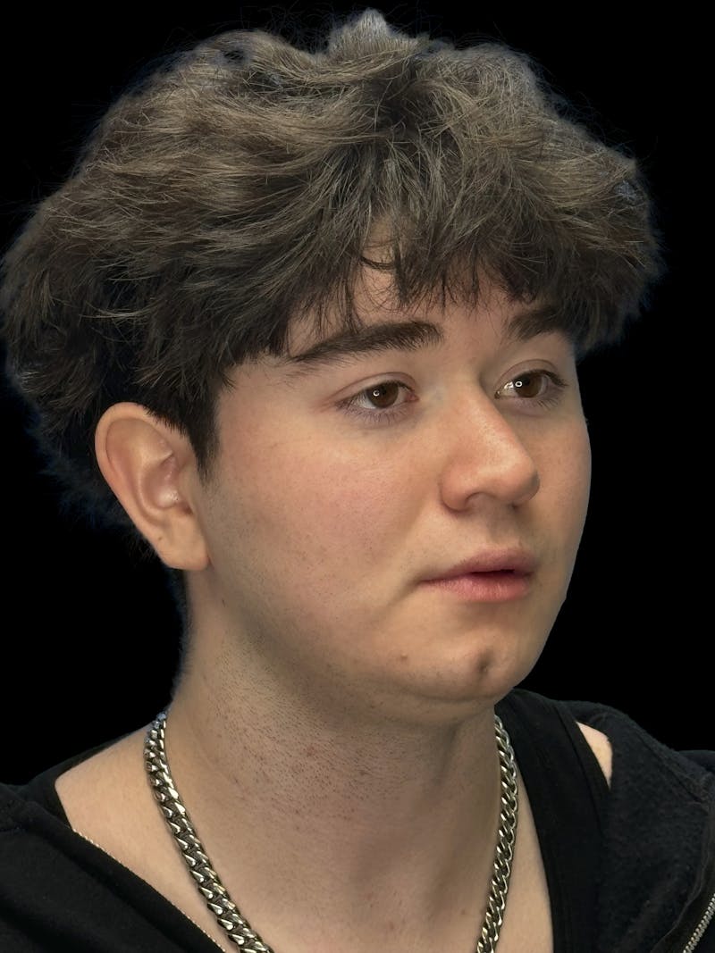 Chin Dimple Surgery Before & After Gallery - Patient 258874 - Image 2