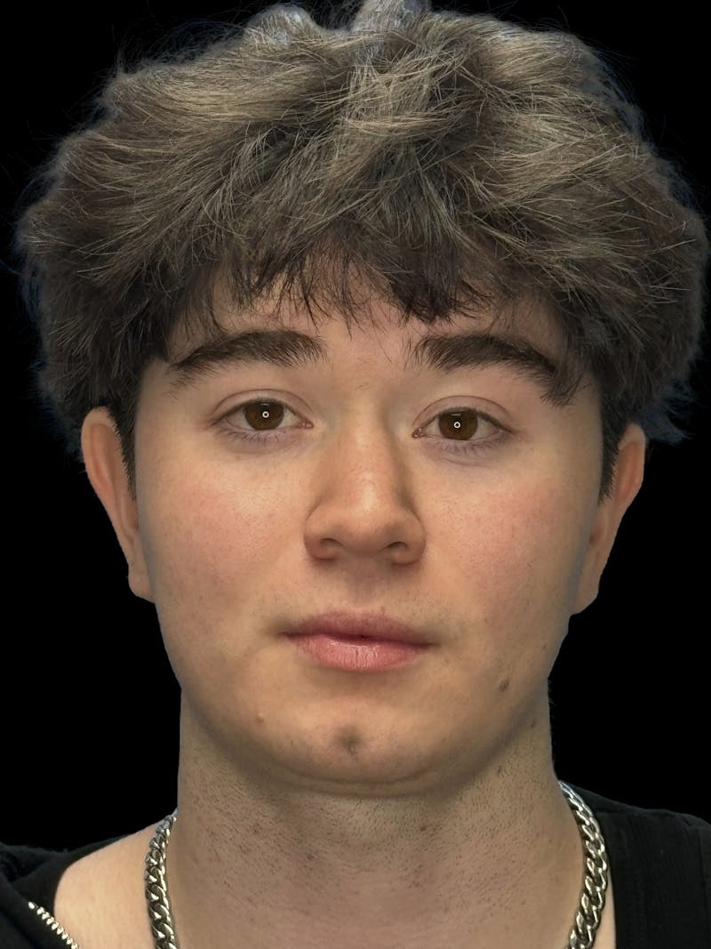 Chin Dimple Surgery Before & After Gallery - Patient 258874 - Image 1