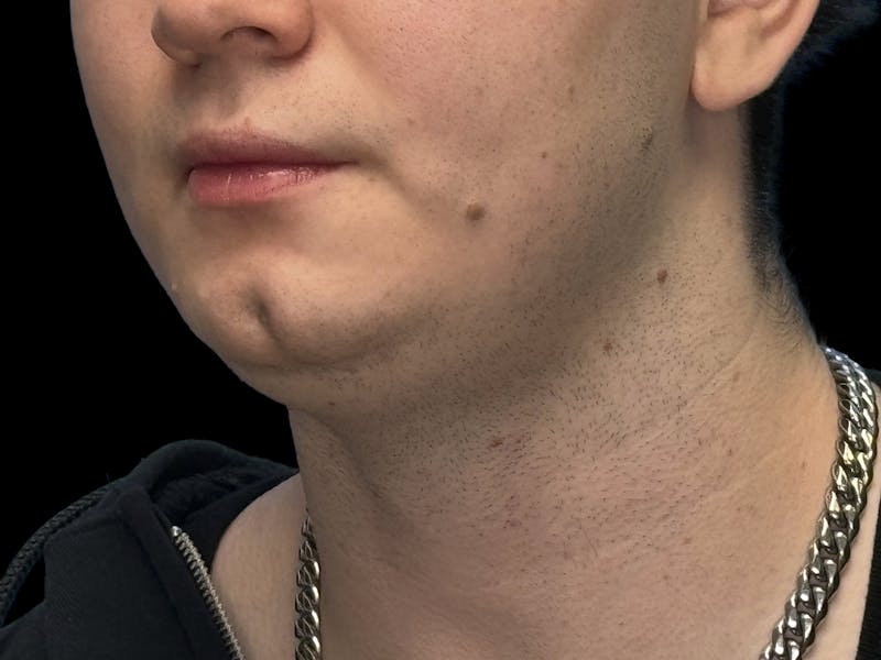 Chin Dimple Surgery Before & After Gallery - Patient 258874 - Image 3