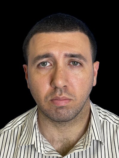 Chin Implant Before & After Gallery - Patient 709517 - Image 2