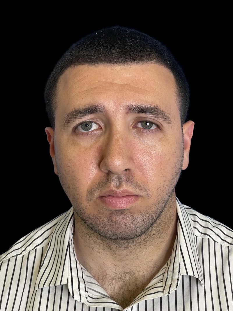 Chin Implant Before & After Gallery - Patient 709517 - Image 2