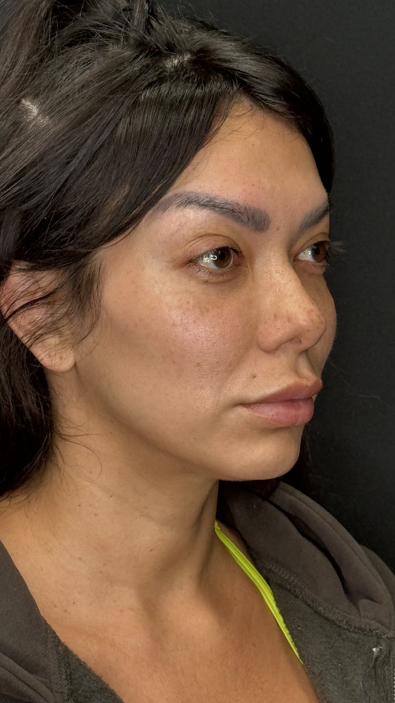 Facial Fat Grafting Before & After Gallery - Patient 401707 - Image 2