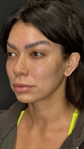 Facial Fat Grafting Before & After Gallery - Patient 401707 - Image 4