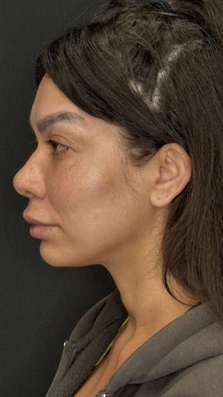 Facial Fat Grafting Before & After Gallery - Patient 401707 - Image 6