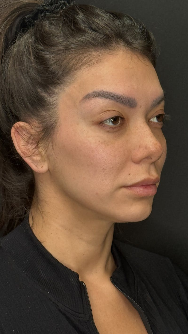Facial Fat Grafting Before & After Gallery - Patient 401707 - Image 1