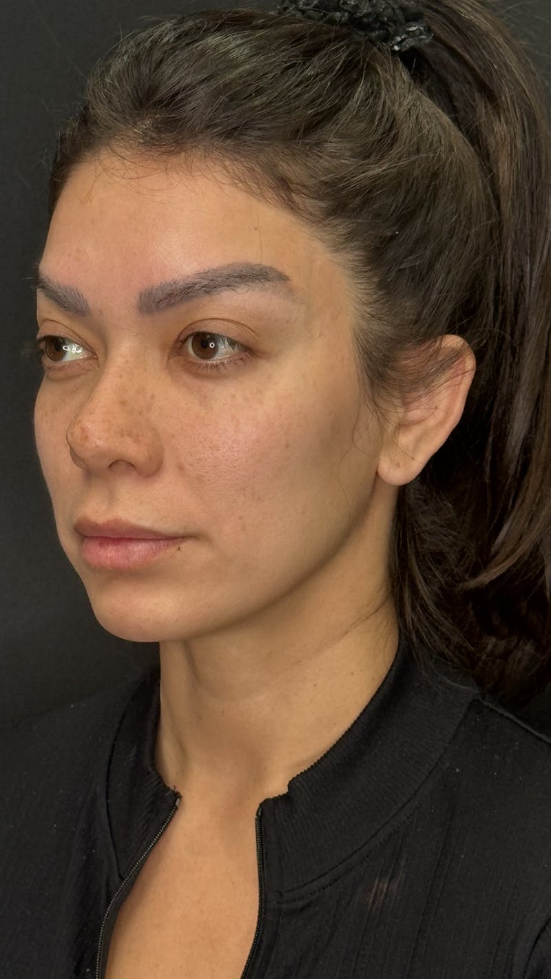 Facial Fat Grafting Before & After Gallery - Patient 401707 - Image 3