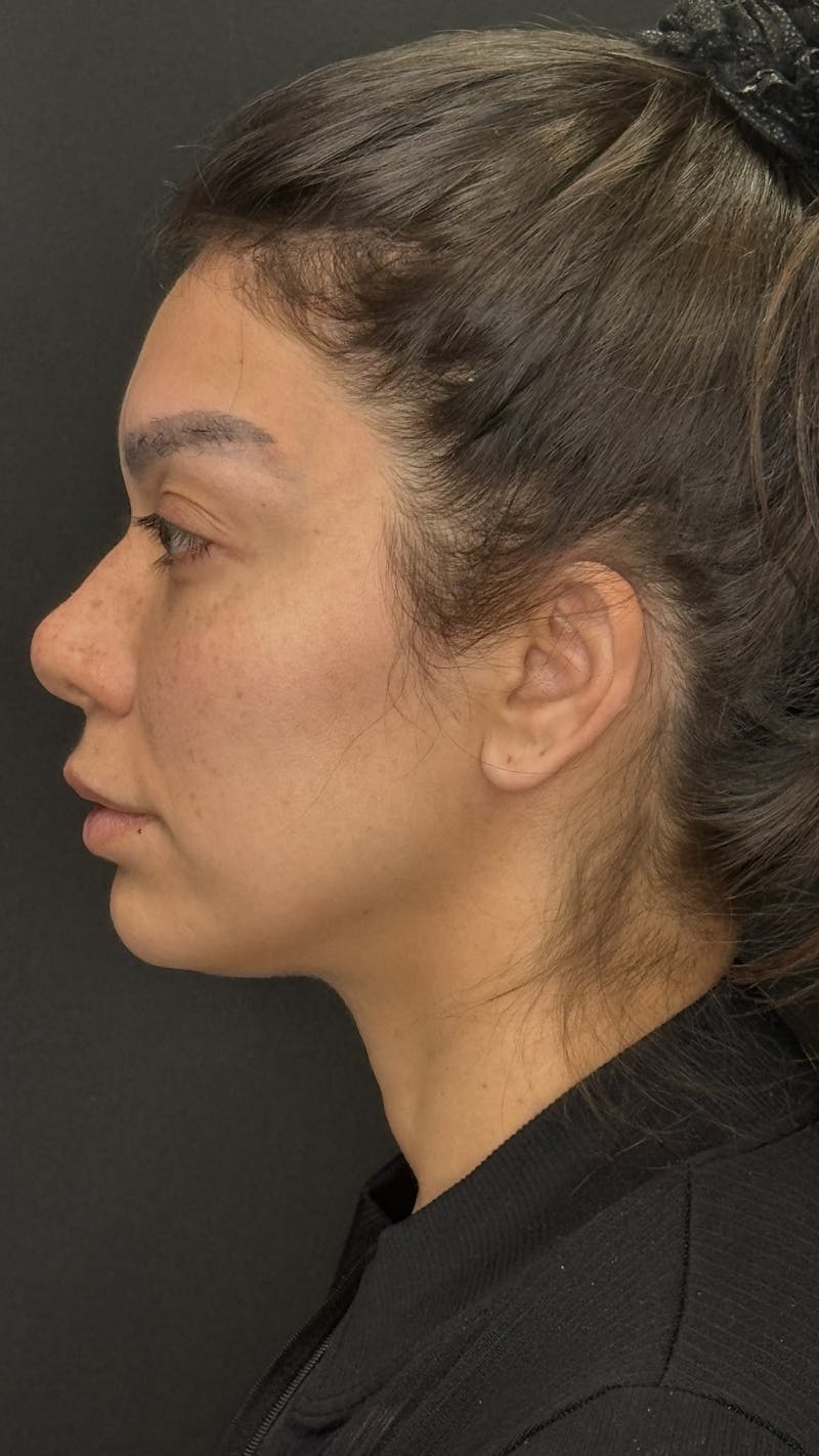 Facial Fat Grafting Before & After Gallery - Patient 401707 - Image 5