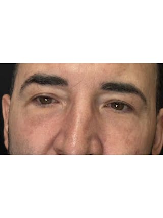 Lower Eye Rejuvenation Before & After Gallery - Patient 237385 - Image 8