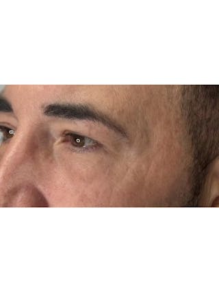 Lower Eye Rejuvenation Before & After Gallery - Patient 237385 - Image 10