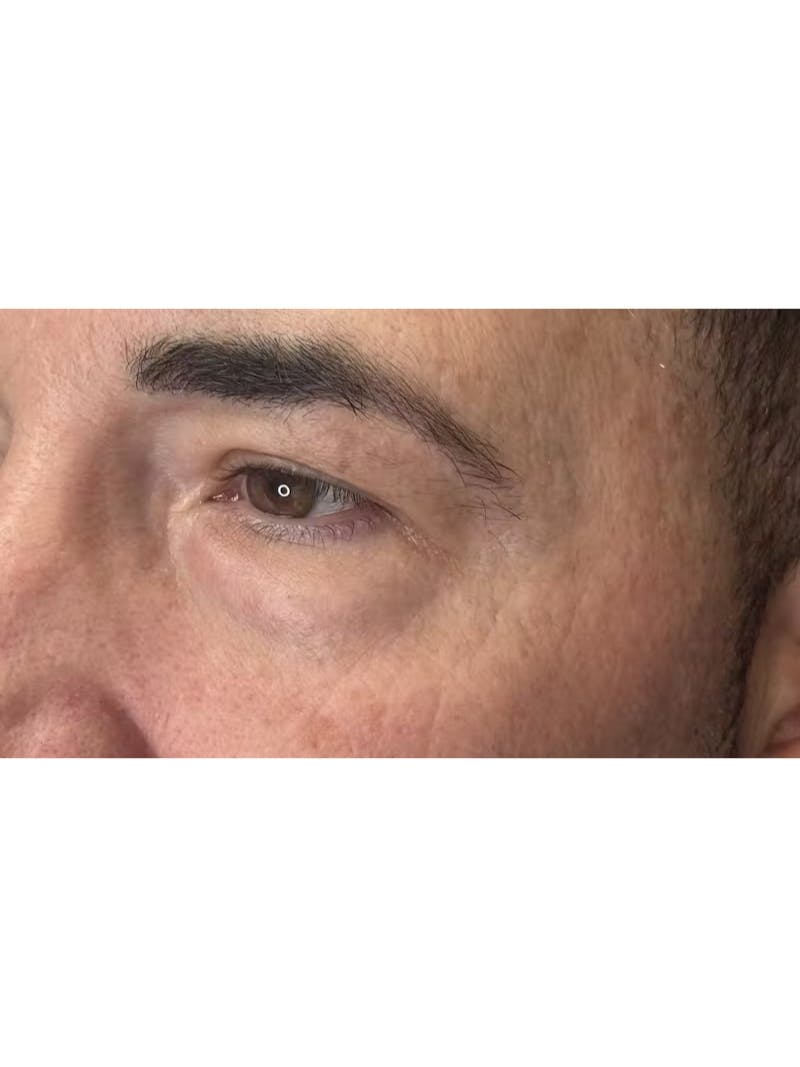 Lower Eye Rejuvenation Before & After Gallery - Patient 237385 - Image 9