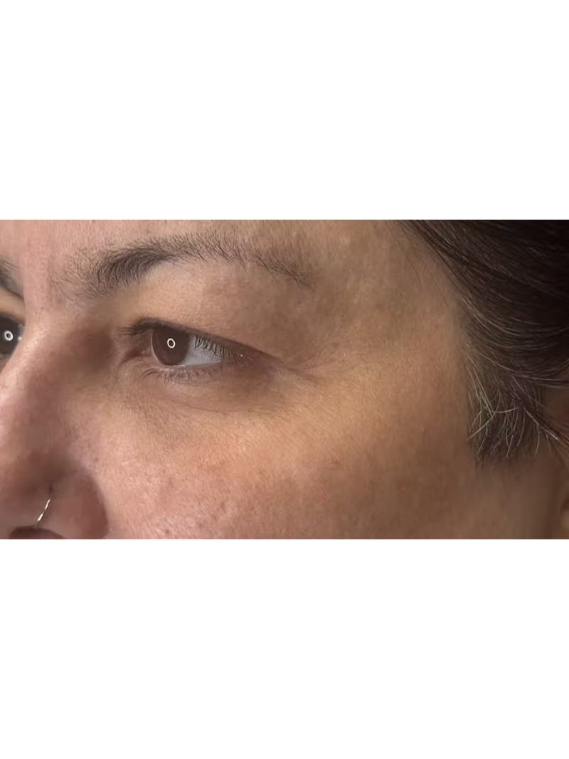 Upper Eye Rejuvenation Before & After Gallery - Patient 133928 - Image 9