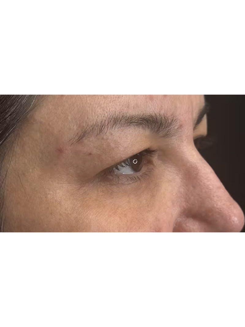 Upper Eye Rejuvenation Before & After Gallery - Patient 133928 - Image 7
