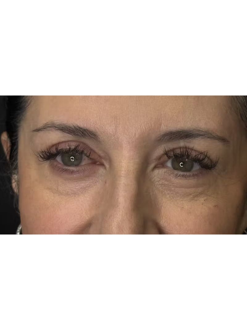 Upper Eye Rejuvenation Before & After Gallery - Patient 208855 - Image 10