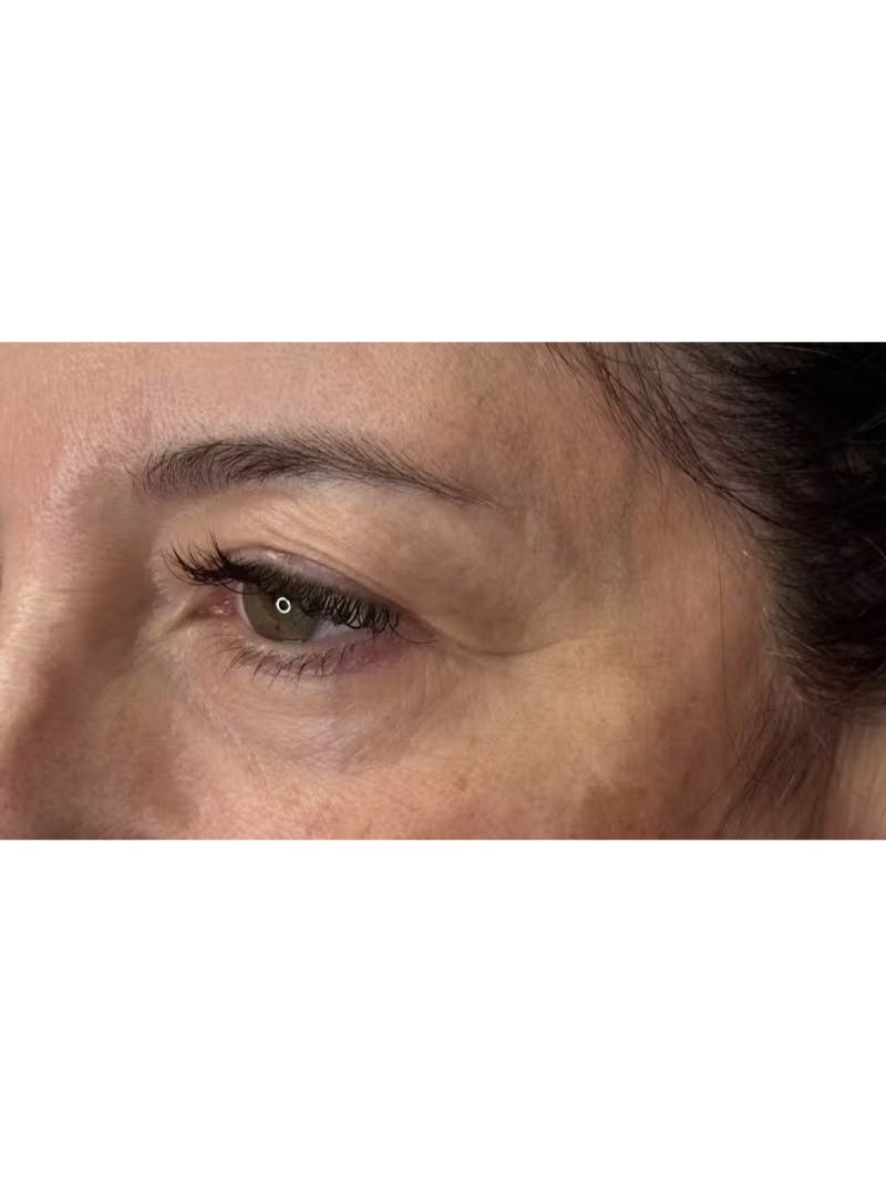 Upper Eye Rejuvenation Before & After Gallery - Patient 208855 - Image 7