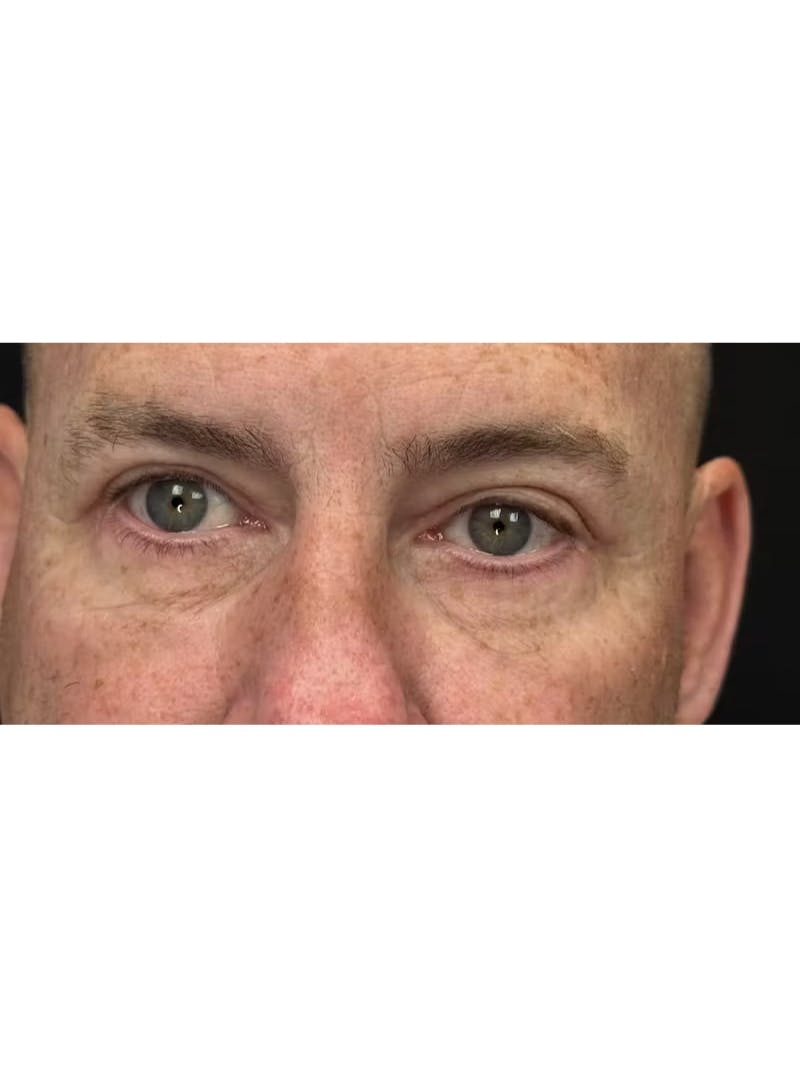 Upper Eye Rejuvenation Before & After Gallery - Patient 634069 - Image 6