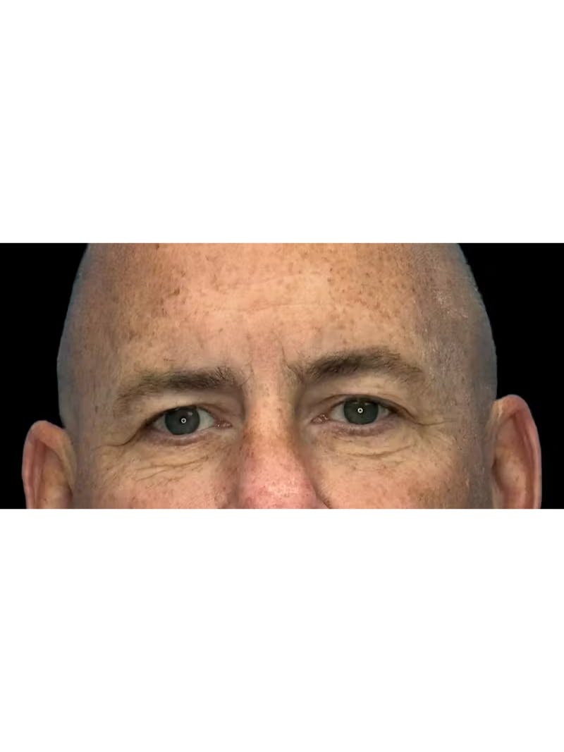 Upper Eye Rejuvenation Before & After Gallery - Patient 634069 - Image 5