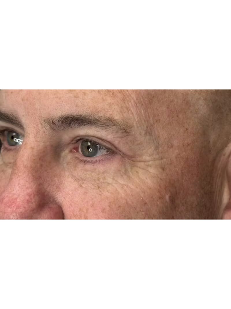 Upper Eye Rejuvenation Before & After Gallery - Patient 634069 - Image 8