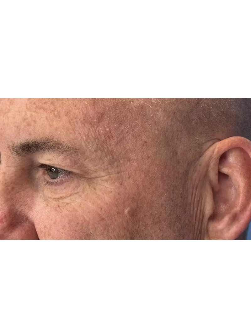 Upper Eye Rejuvenation Before & After Gallery - Patient 634069 - Image 7