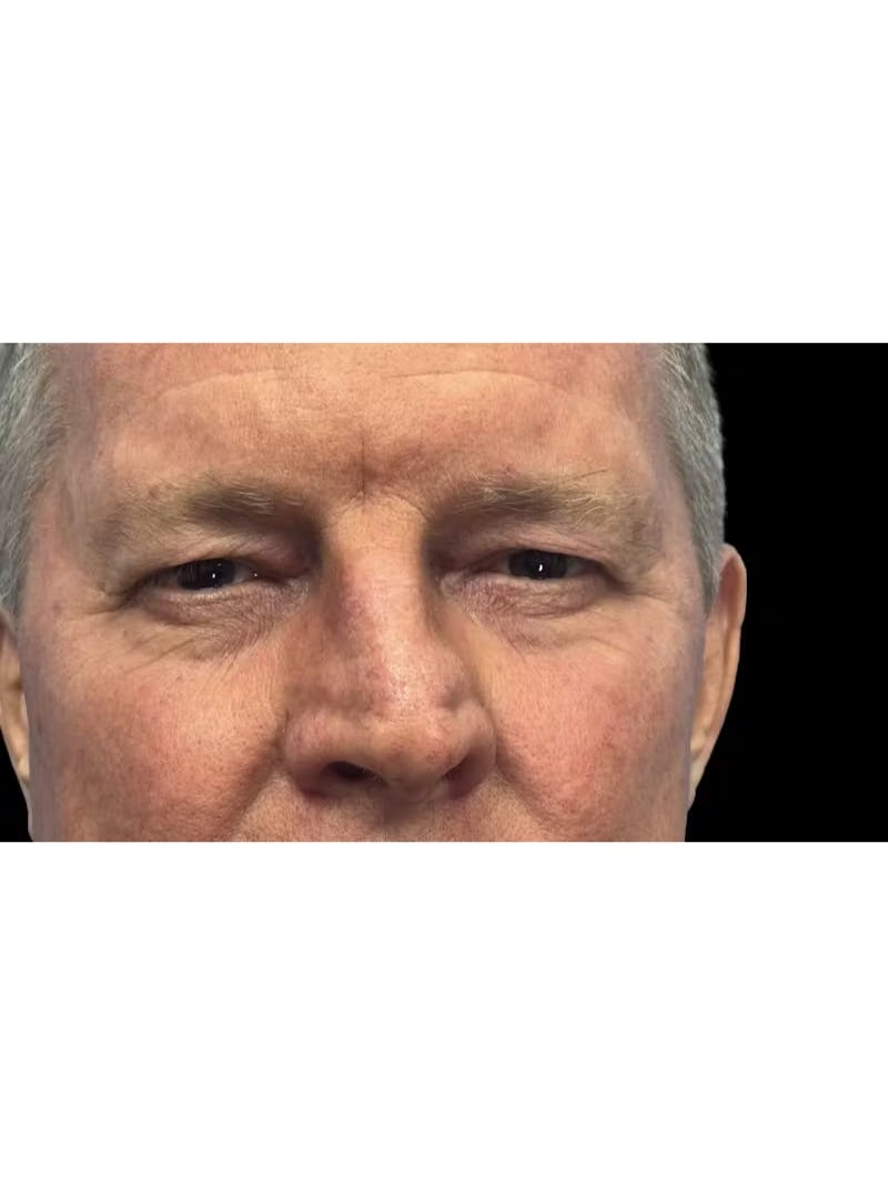 Upper Eye Rejuvenation Before & After Gallery - Patient 168724 - Image 5