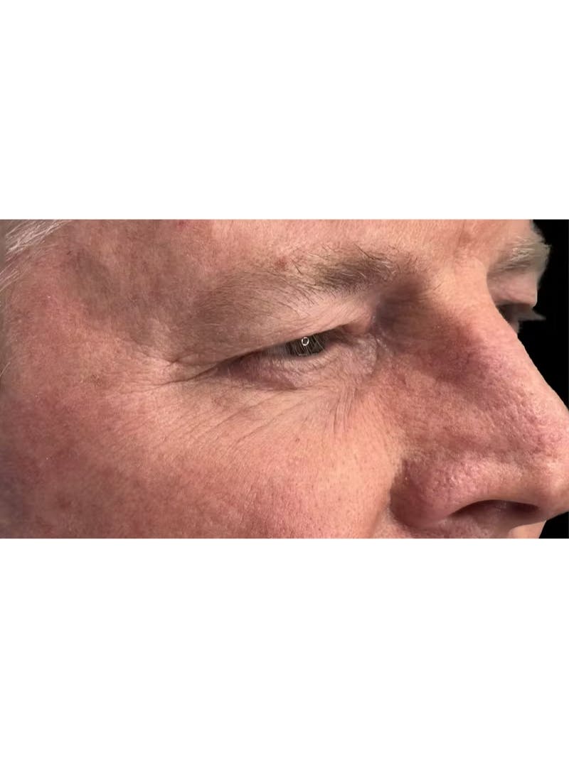 Upper Eye Rejuvenation Before & After Gallery - Patient 168724 - Image 7