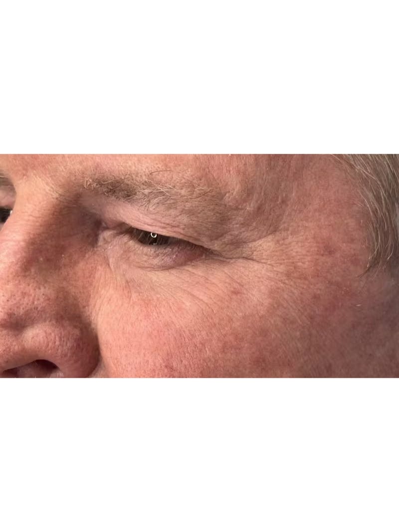 Upper Eye Rejuvenation Before & After Gallery - Patient 168724 - Image 9