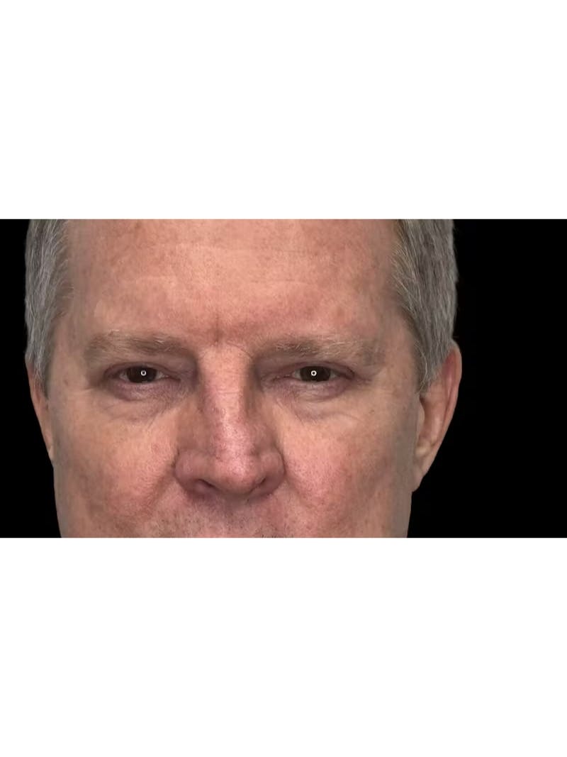 Upper Eye Rejuvenation Before & After Gallery - Patient 168724 - Image 6