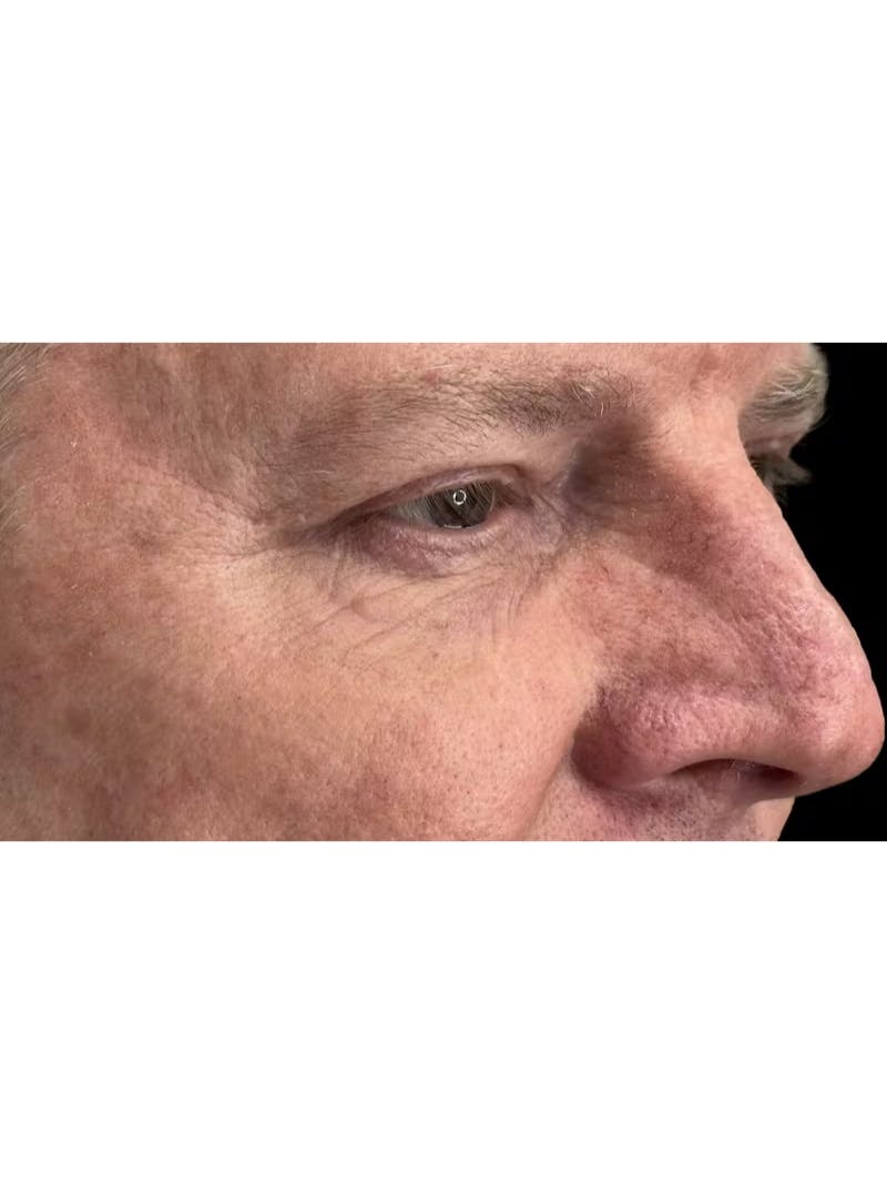 Upper Eye Rejuvenation Before & After Gallery - Patient 168724 - Image 8