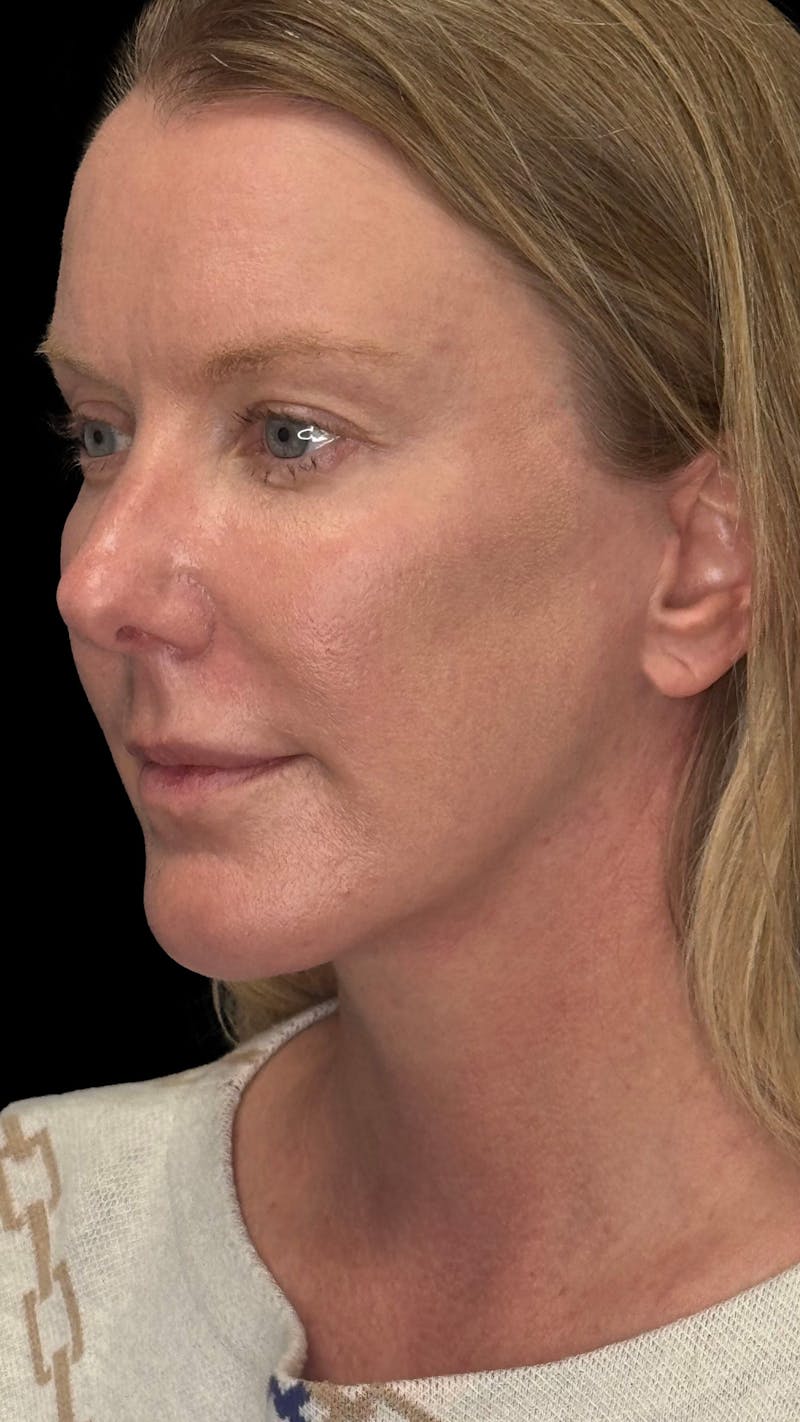 Deep Plane Facelift & Neck Lift LP Before & After Gallery - Patient 234780 - Image 2