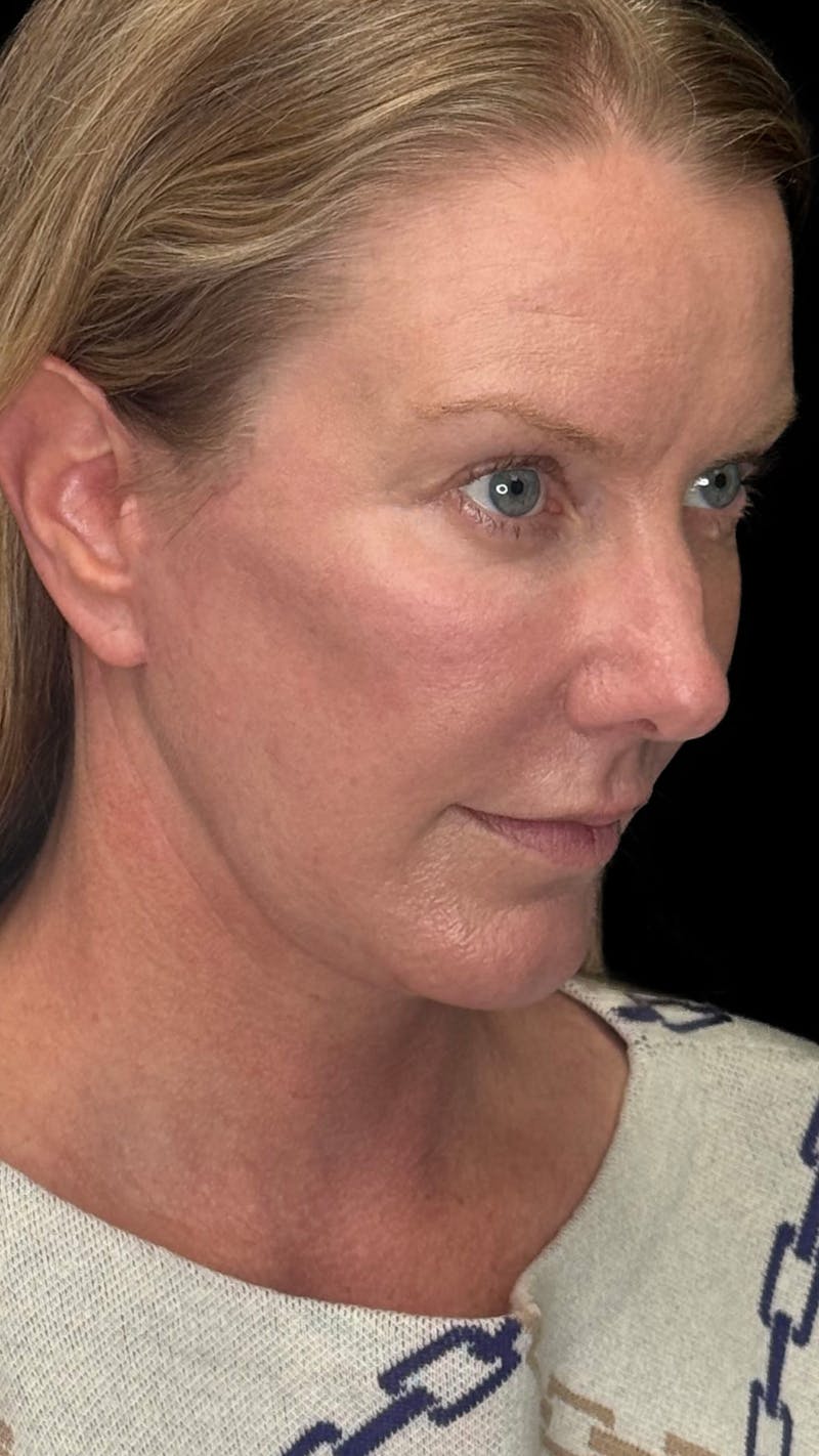 Deep Plane Facelift & Neck Lift LP Before & After Gallery - Patient 234780 - Image 4