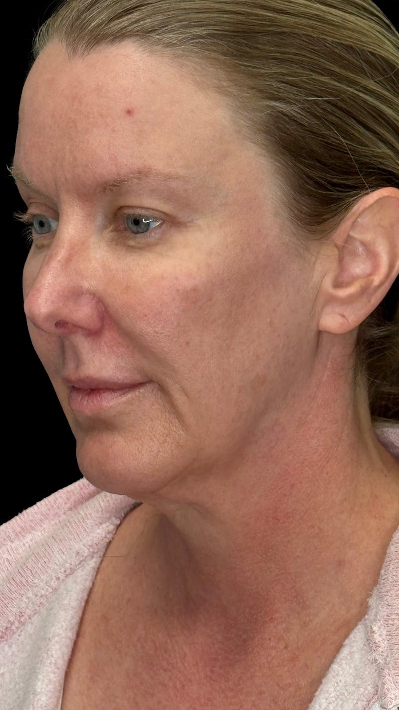 Deep Plane Facelift & Neck Lift LP Before & After Gallery - Patient 234780 - Image 1