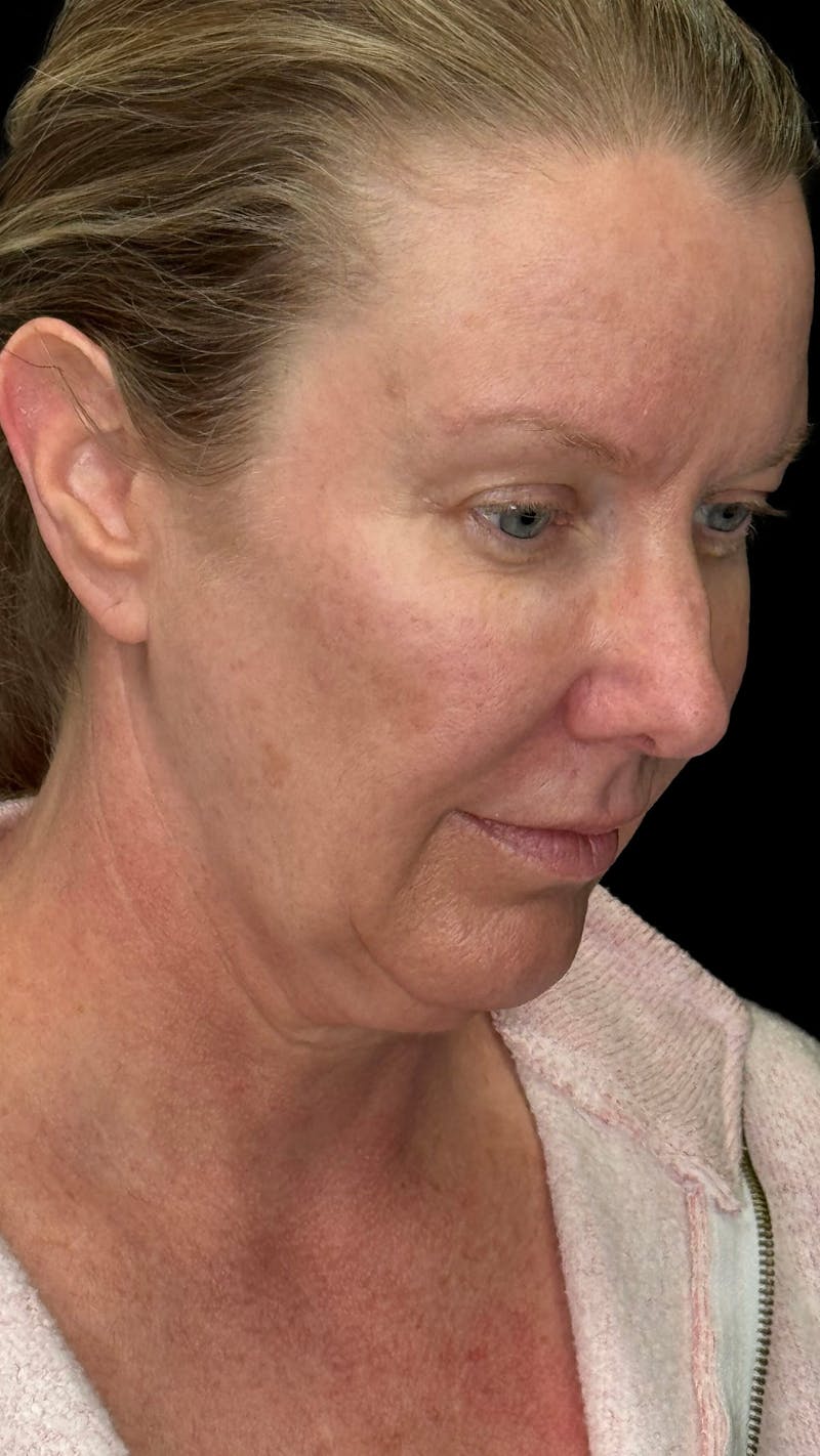 Deep Plane Facelift & Neck Lift LP Before & After Gallery - Patient 234780 - Image 3