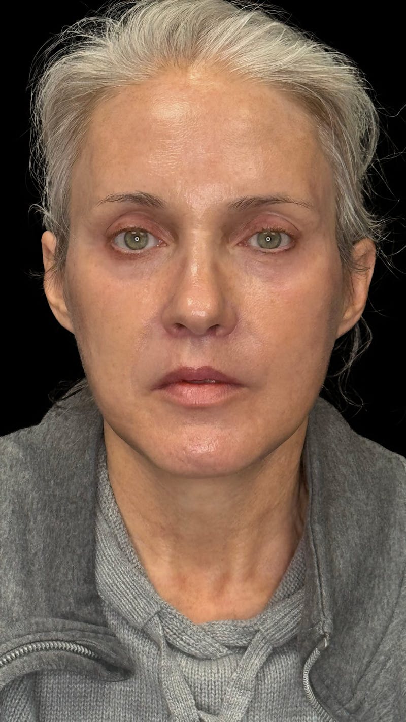 Deep Plane Facelift & Neck Lift LP Before & After Gallery - Patient 672317 - Image 2