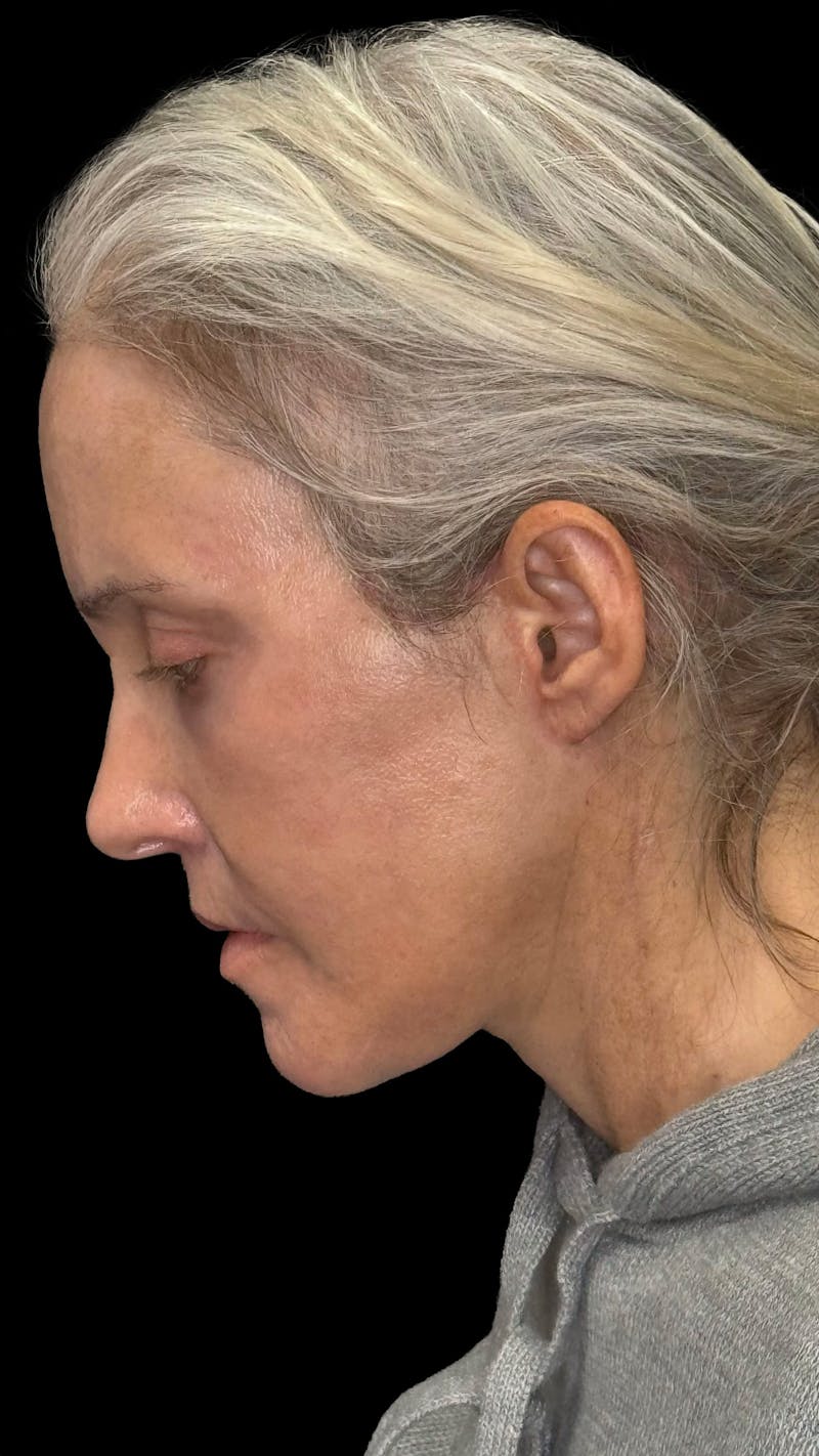Deep Plane Facelift & Neck Lift LP Before & After Gallery - Patient 672317 - Image 4