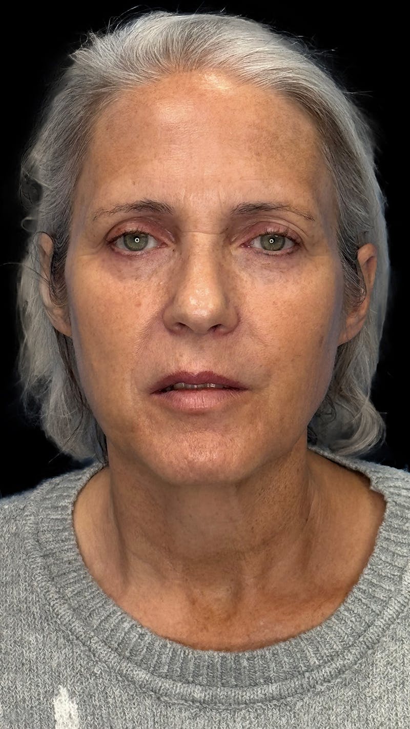 Deep Plane Facelift & Neck Lift LP Before & After Gallery - Patient 672317 - Image 1