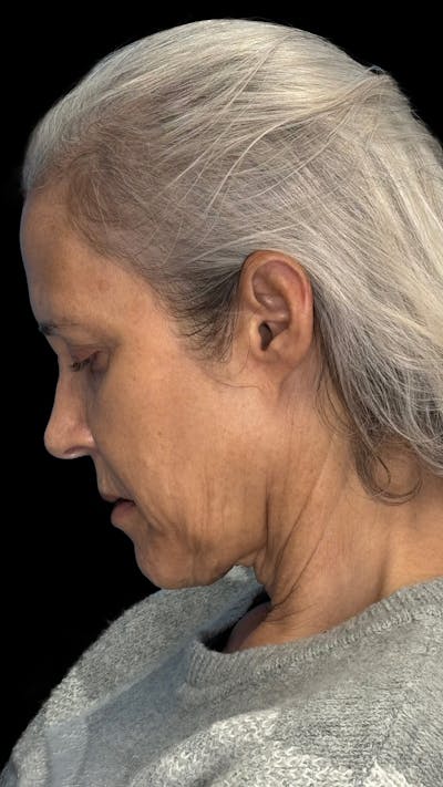 Deep Plane Facelift & Neck Lift LP Before & After Gallery - Patient 104911 - Image 1