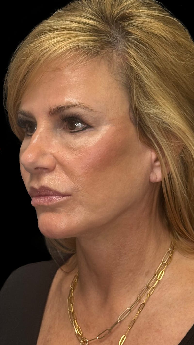 Deep Plane Facelift & Neck Lift LP Before & After Gallery - Patient 200071 - Image 2