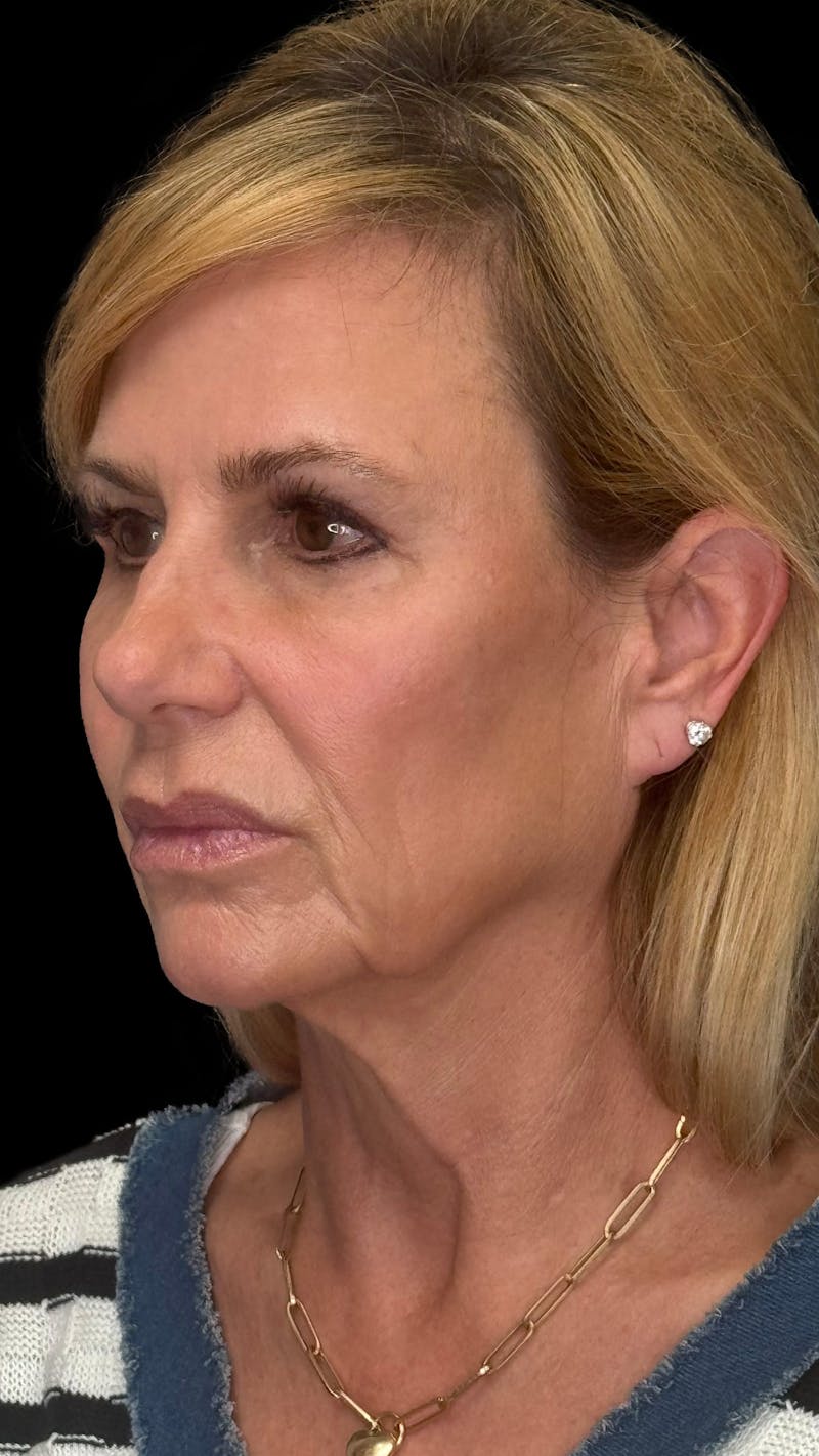 Deep Plane Facelift & Neck Lift LP Before & After Gallery - Patient 200071 - Image 1