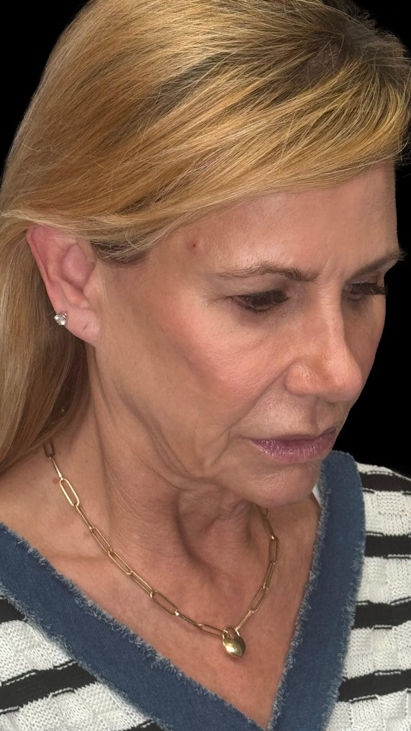 Deep Plane Facelift & Neck Lift LP Before & After Gallery - Patient 200071 - Image 3