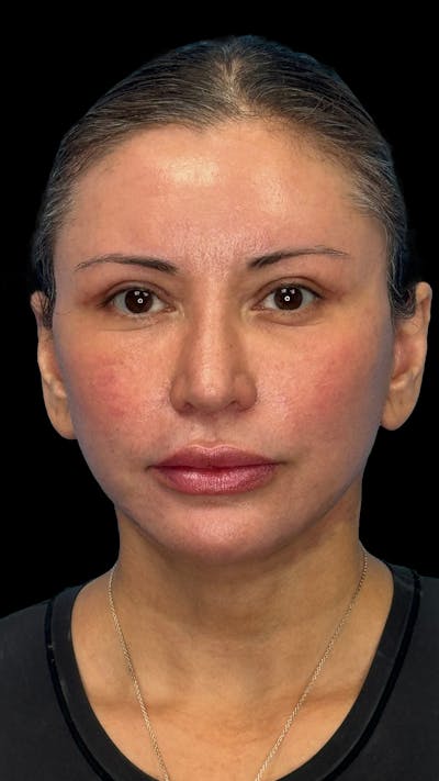 Deep Plane Facelift & Neck Lift LP Before & After Gallery - Patient 390320 - Image 2