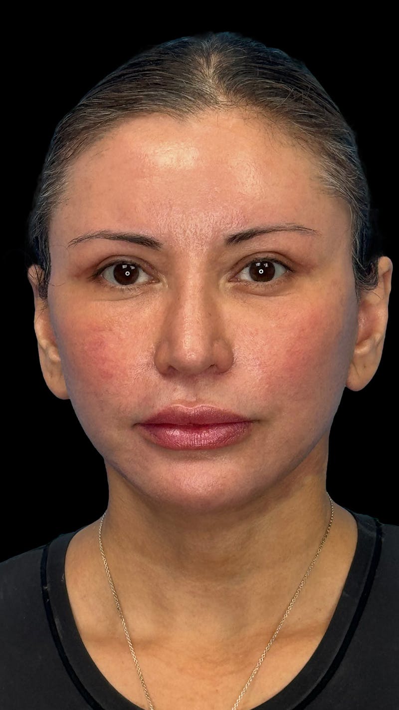 Deep Plane Facelift & Neck Lift LP Before & After Gallery - Patient 390320 - Image 2
